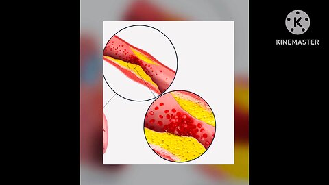 Heart||myocardial infraction||treatment||Heart disease