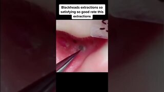 Full Ear Blackheads Removal