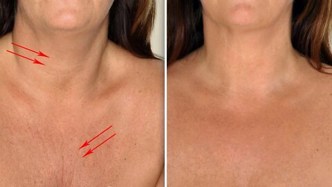 How to Get Rid of Chest and Neck Wrinkles Naturally