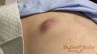 Drainage of an infected cyst on the back