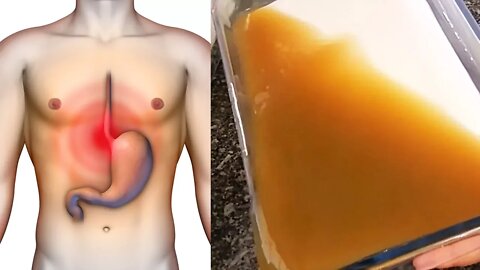 How to Treat Stomach Ulcers, Acid Reflux and Gastritis Naturally