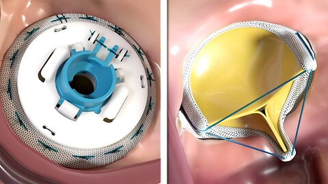 Mitral valve replacement technology - 3D animation