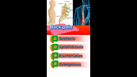 Back pain question answered mcqs #pain #joinpain #pain #medication #painkiller #drugs