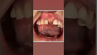 Tooth Root Excretion