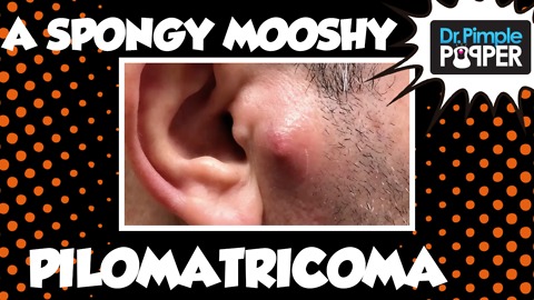 A Spongy Mooshy Pilomatricoma