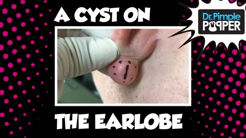 A Cyst Hiding Behind the Earlobe! With Dr Pimple Popper