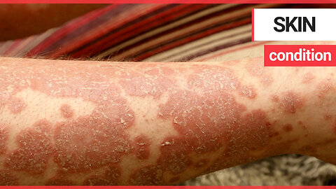 Anti-inflammatory biologic drugs prevent heart disease in psoriasis sufferers