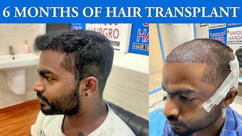 6 Months Of Hair Transplant Result