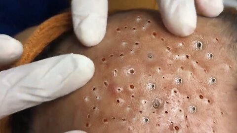 Removing Pimples and Blackheads from the Face, #09