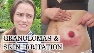 Treating Granulomas & Skin Irritation with an Ostomy | Let's Talk IBD