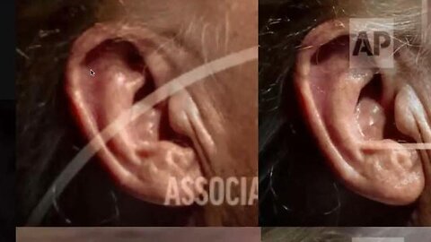 Trump's ear anomaly