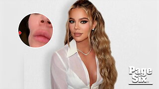 Khloé Kardashian shows off huge indentation on cheek after skin cancer removal