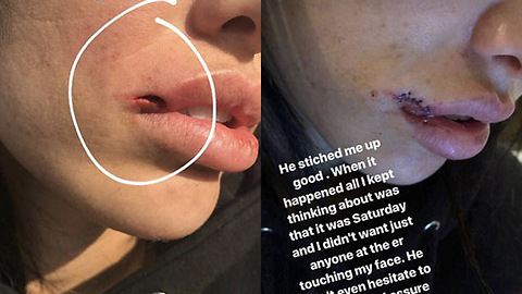 OUCH! Johnny Manziel's Fiance Gets Her Lip RIPPED OFF by a Dog!