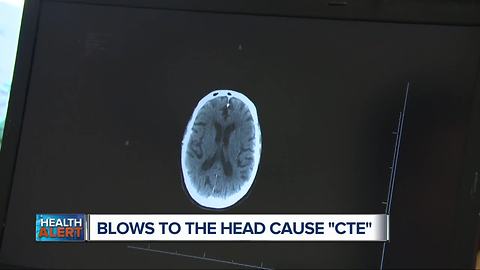 Blows to the head, not concussions, cause the degenerative brain disease CTE