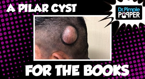 A Pilar Cyst For The Books
