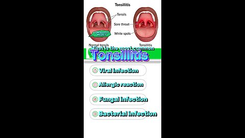 Tonsillitis mcq #gland #hormones #life #allergy #short #disease tonsillectomy