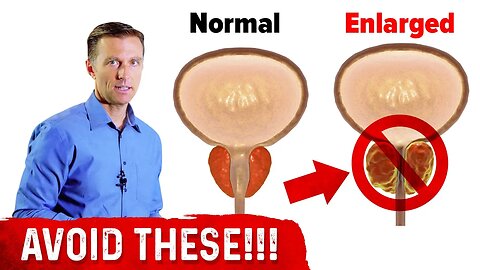 4 Things to Avoid if You Have an Enlarged Prostate – Dr. Berg