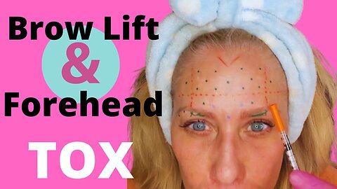 How to DIY Botox ( Tox ) Forehead, 11’s and Add a Brow Lift. SASSY10 saves you 10%