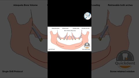 Quickdent dental implant #dental