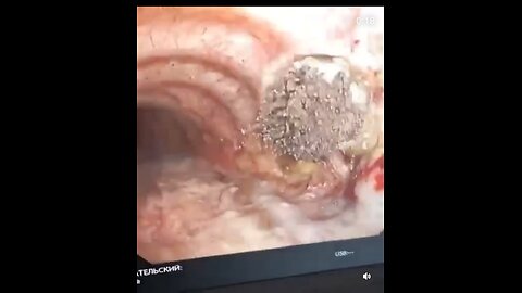 Inside the Jabbed Esophagus!!