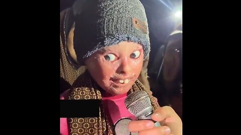 Effects of White Phosphorus Used by jEEWs on Palestinian Girl. She Lost Her Eyelids.