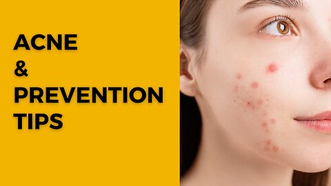 Understanding Acne and Its Prevention