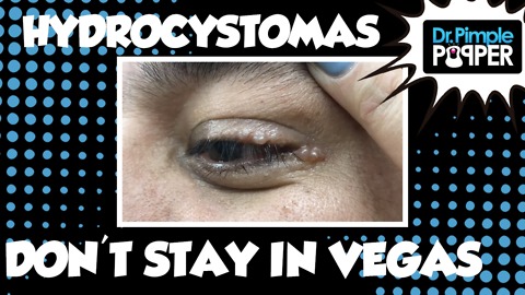 Hidrocystomas don't stay in Vegas