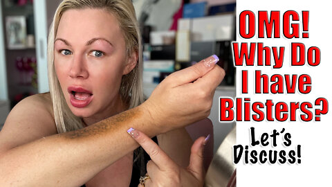 OMG! Why Do I Have Blisters? Let's DIscuss! | Code Jessica10 saves you Money At All Approved Vendors