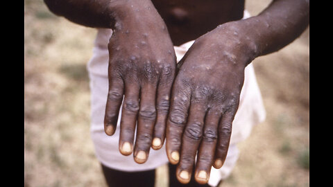 UN health agency declares monkeypox a global emergency