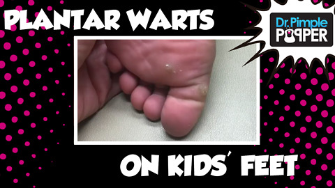 Plantar Warts on my kids' feet