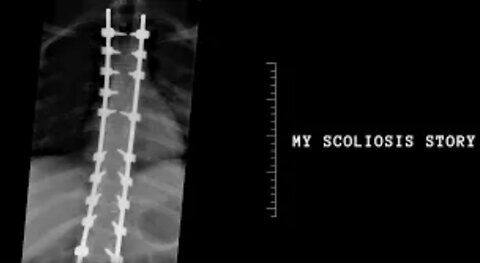 My Scoliosis Story || 4 Rods & 36 Screws
