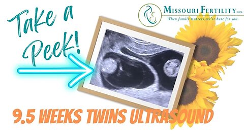 Ultrasound of Twin Pregnancy at 9 1/2 weeks