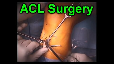ACL Knee Orthopaedic Reconstruction Surgery