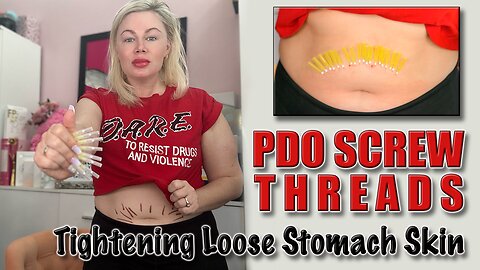 Tighten Loose Stomach Skin with PDO Screw Threads! AceCosm, Code Jessica10 Saves you Money