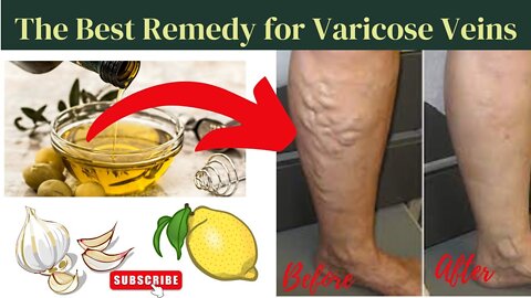 The Best Varicose Veins Treatment | Varicose Veins Cure Fast At Home