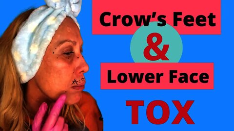 How to DIY Botox (Tox) Lower Face for Lift & How to Mark Crows Feet.