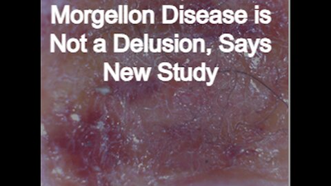 Morgellons When does a “delusion” become reality?