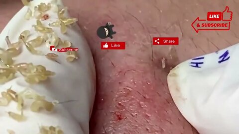 Blackhead Removal - Beautiful removal of blackheads from the face