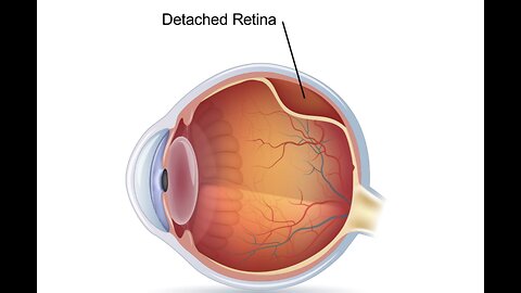 Detached Retina Dr Joel Wallach