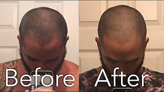 How I Stopped My Hair loss Naturally