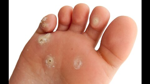 How to Treat Warts and Verrucas