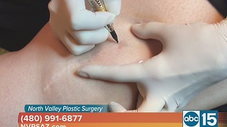North Valley Plastic Surgery helps get rid of unwanted scars with paramedical tattooing