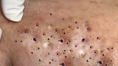 Removing Acne and Blackheads Treatment, #44
