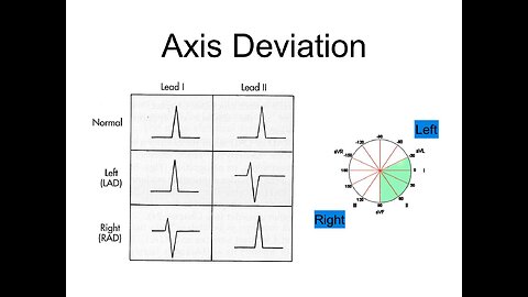 ECG Axis - Causes of Axes Deviation on ECG