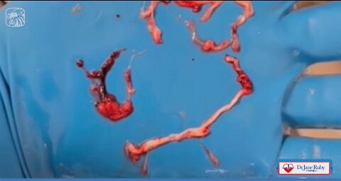 Worldwide Exclusive - Embalmers Find Veins & Arteries Filled with Never Before Seen Rubbery Clots