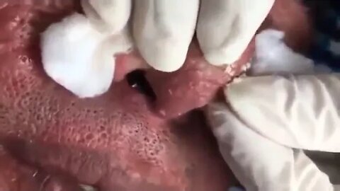 Nose blackhead removal l Beautiful extraction! Cravos