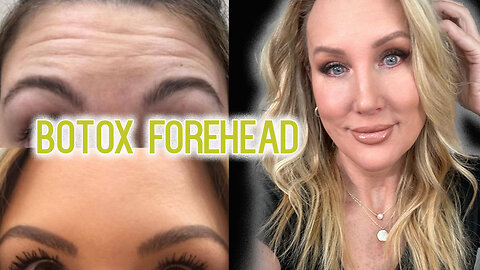 TOX FOREHEAD TREATMENT // Full Video Tutorial