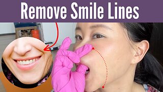 How to remove smile lines naturally! | Koko Face Yoga