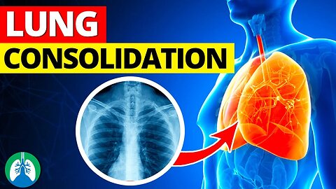 Lung Consolidation (Medical Definition) | Quick Explainer Video