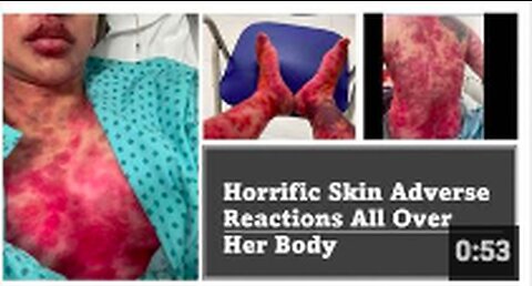 Post AstraZeneca, This Woman Suffers Horrific Skin Reactions All Over Her Body - Doctors Are Baffled